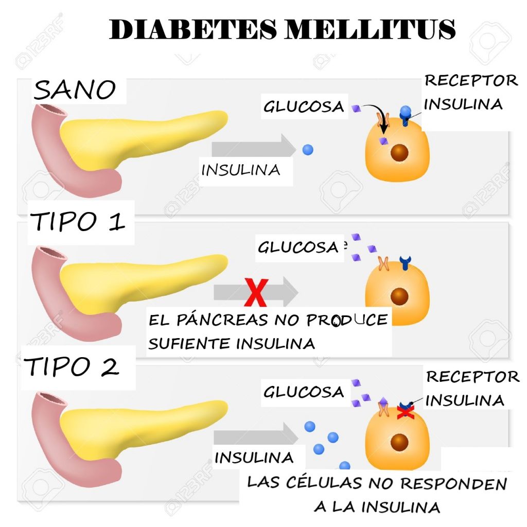 Tipos de diabetes. diabetes mellitus tipo 1 y diabetes tipo 2